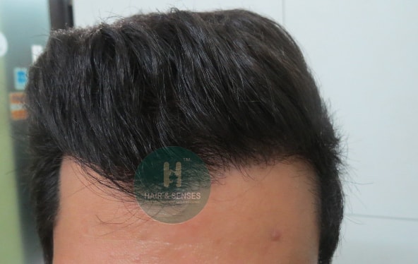 Hair Transplant Case Study